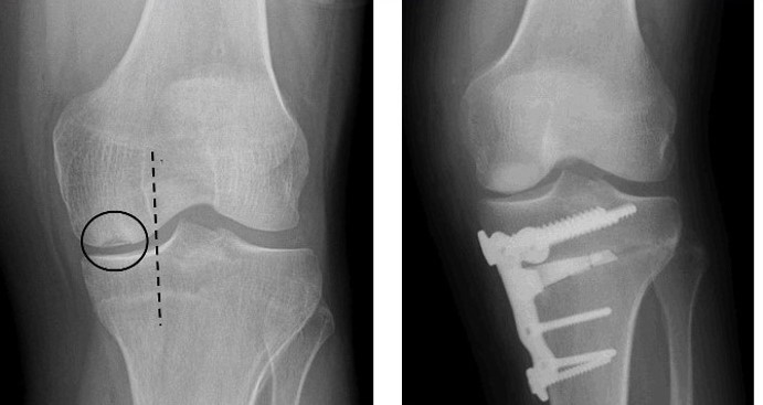 AI-Powered Surgical Planning for Knee Osteotomy
