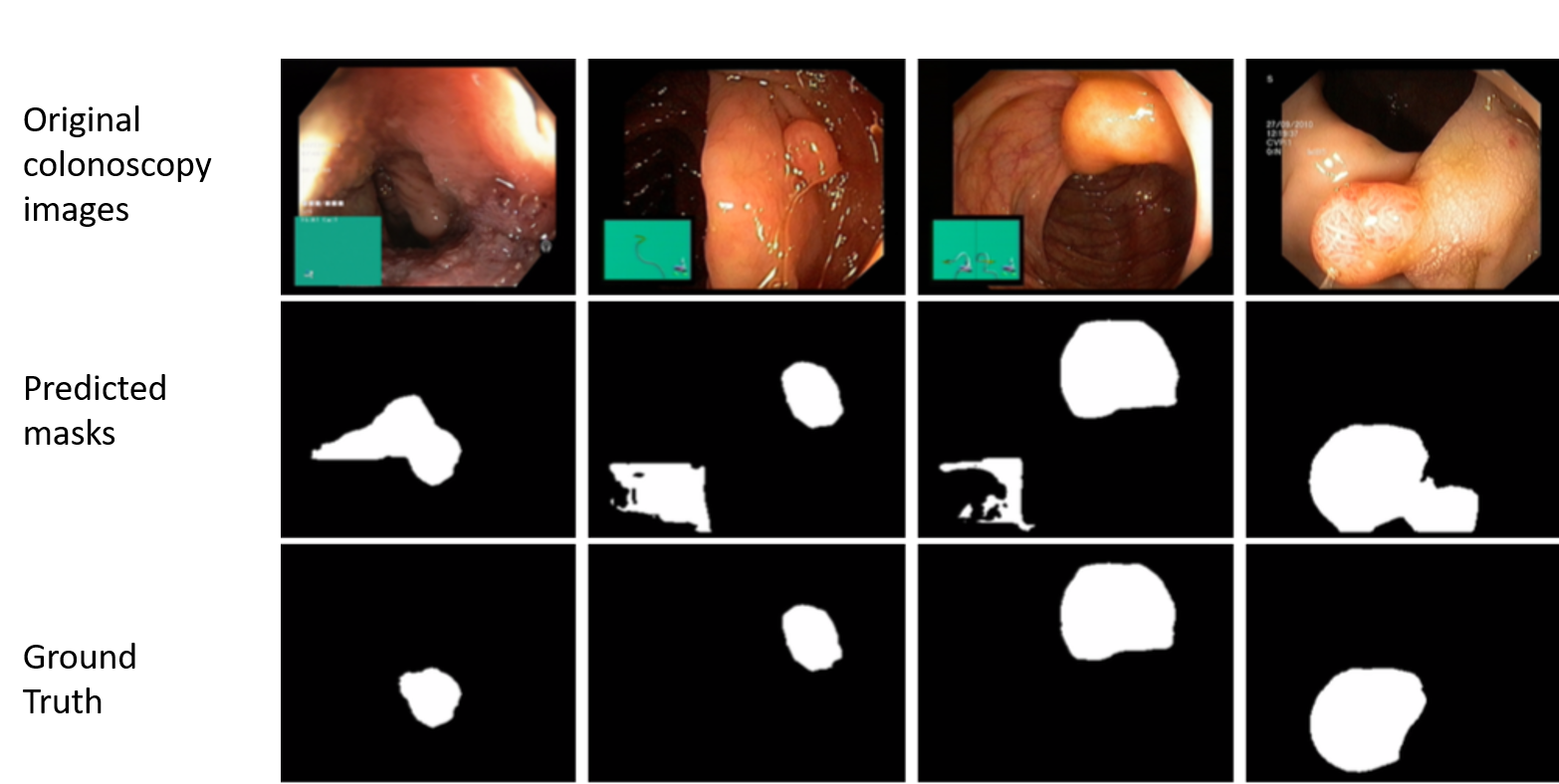 GI Tract Anomaly Detection from Endoscopy Images