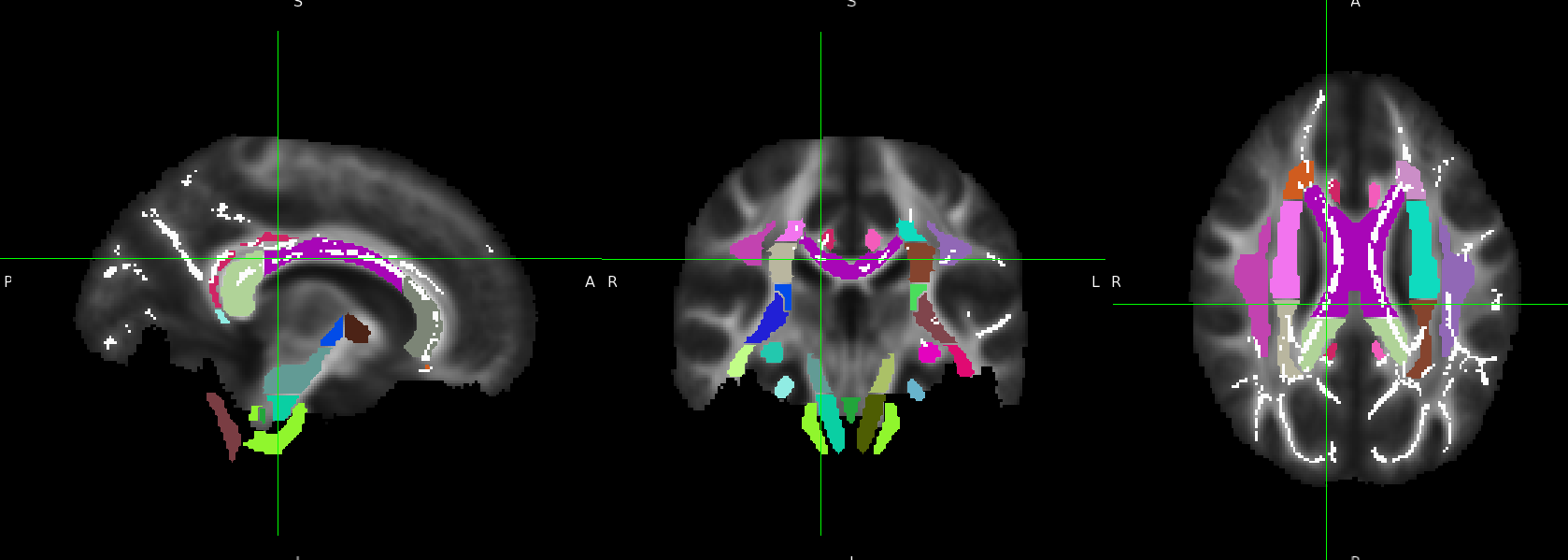 Structural connectivity analysis in autism spectrum disorder using diffusion tensor imaging (DTI)